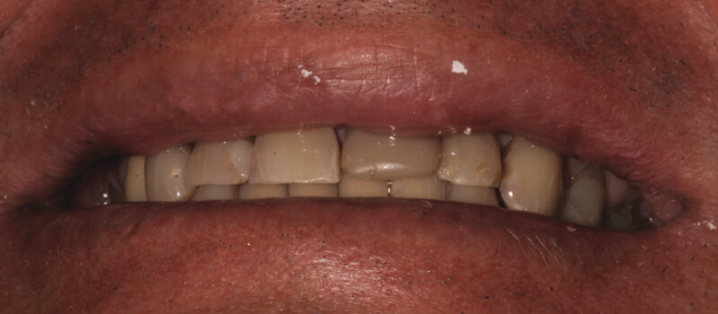 man's teeth before vero beach dentistry