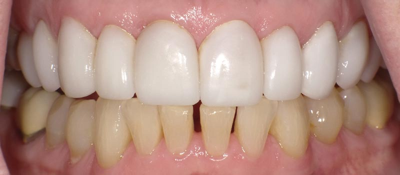 laura teeth before vero beach dentistry