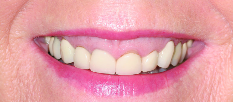 teeth before vero beach dentistry