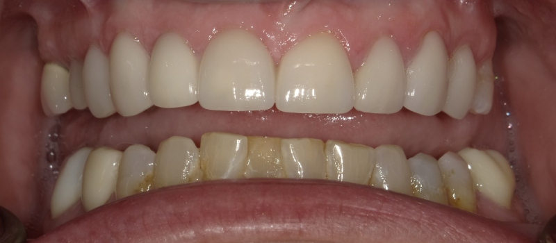close up view of patient's teeth