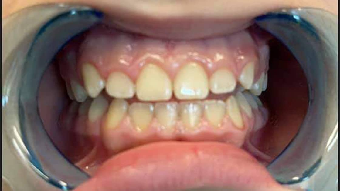 Airway-2-Before