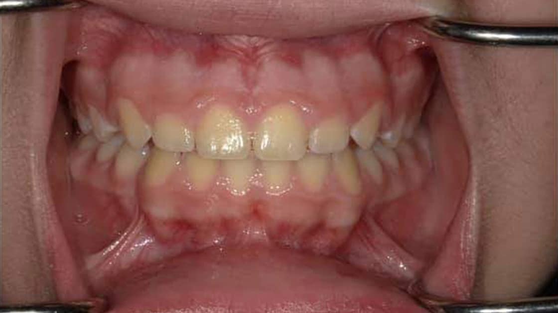 Airway-2-After