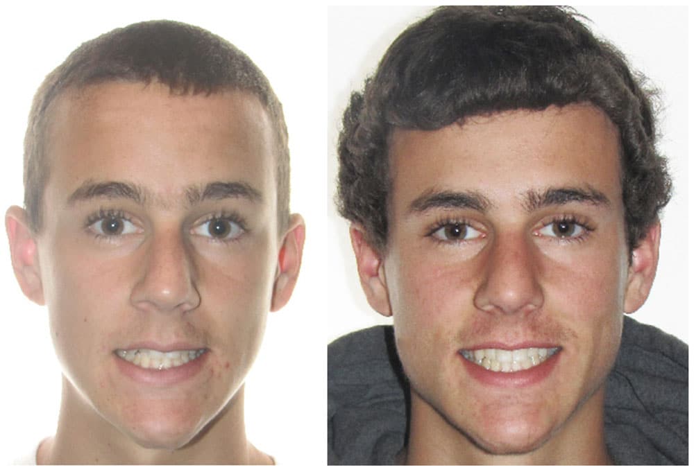 Invisalign Teen Boy Before and After Photo