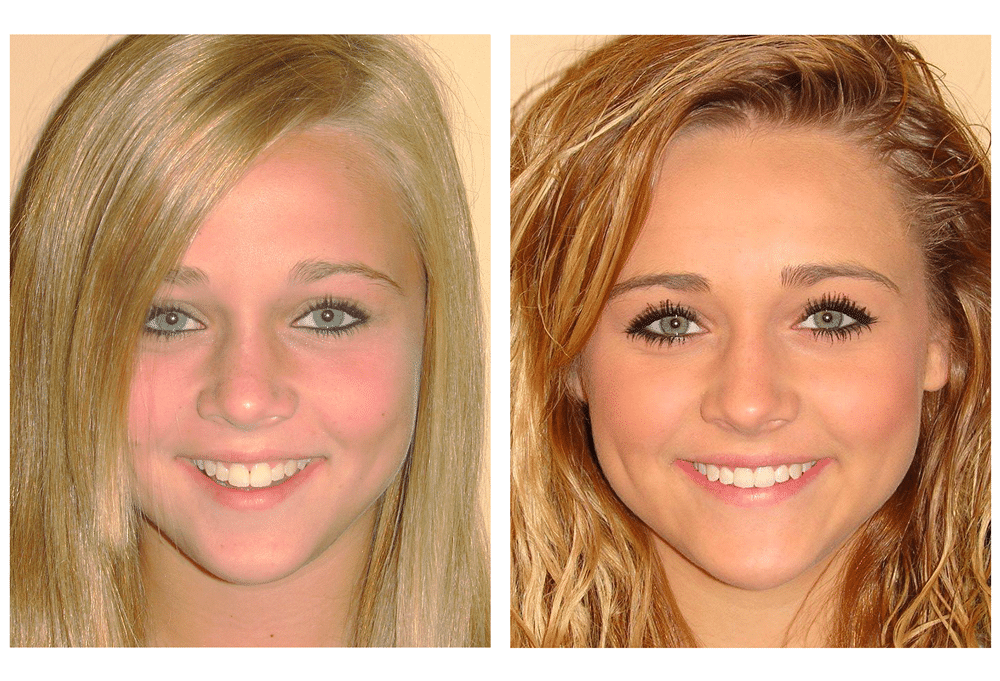 Invisalign Teen Girl Before and After Photo